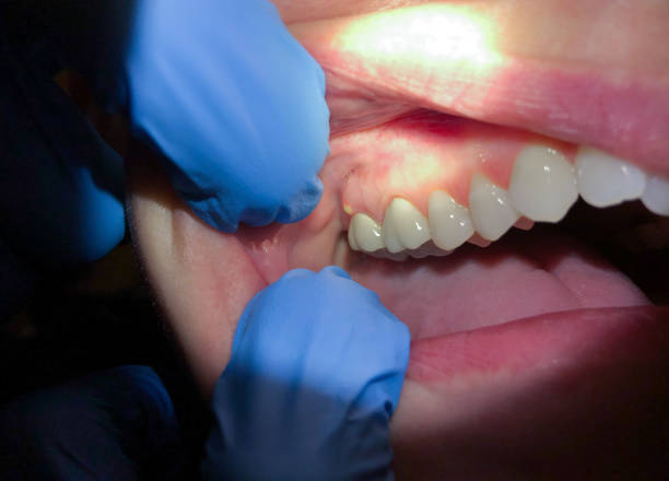 Best Dentist for Tooth Abscess  in Ellerslie, GA